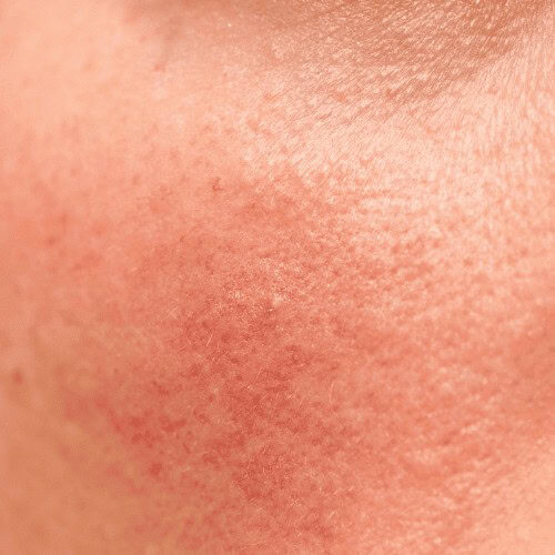 A close-up picture of a sensitive skin on the cheek